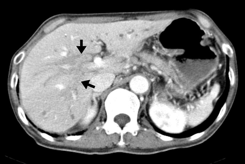 (A) CT scan demonstrated intrahepatic biliary dilatation secondary to diffuse stricturing of the biliary system and bile duct wall thickening at hilar portion