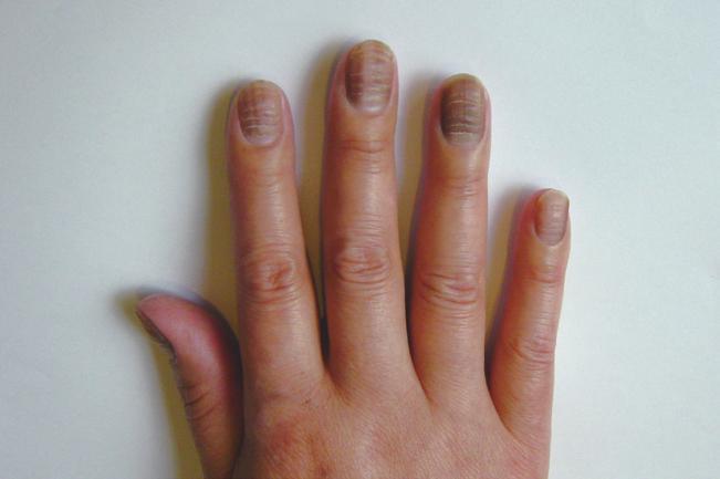 22 항암제치료에대한이해 23 13) 손, 발톱의변화 15) 항암제유출 ( 혈관밖으로새어나감 ) 에의한피부손상 손, 발톱이검게착색되거나누렇게변하며표면에줄이생기고딱딱해질수 있습니다. 손, 발톱이들뜨고, 염증이생길수있습니다. 쉽게부서지거나빠지기도 합니다.
