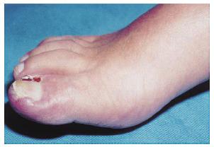 이러한항암제가투여되는경우에는혈관상태를확인하고, 필요시중심정맥관을 삽입하여안전하게투여합니다. 이러한변화는치료가끝난후수개월이지나면자연적으로회복됩니다. 손 발톱주변에염증이생기는경우에는감염이되지않도록청결하게 유지하고의료진과상의하십시오. 이차감염을예방하기위해항생제가 투여될수도있습니다.