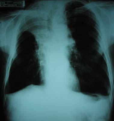 Tuberculosis and Respiratory Diseases Vol. 57. No. 4, Oct, 2004 A B C Figure 2. Radiologic changes of patient after PDT. A; Chest PA on admission-right upper lobe atelectasis is seen.