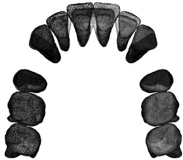 Vol. 41, No. 4, 2011. Korean J Orthod 연속호선과분절호선의유한요소분석 Fig 6. Contour plot of lateral displacement of continuous and segmented arches with miniscrews in the palatal slope.