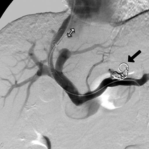 Coil embolization of the varices was additionally performed after the TIPS procedure due to insufficient decompression of the varices (solid arrow). Note.