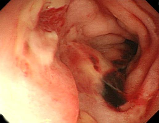 Figure 2. Colonoscopic findings. (A) It shows several edematous hyperemic mucosal patch on the ileocecal valve. (B) It shows a large deep ulcer with spontaneous bleeding in the terminal ileum.