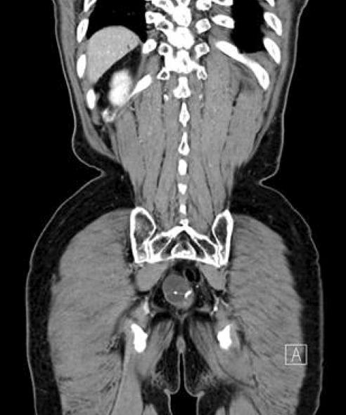 Figure 1. Abdominopelvic CT findings. An 3.1 cm sized cyst lesion with nonenhancing thin wall is seen at the anastomotic site. A hyperdense linear disrupt clip is seen within the cyst (arrow).