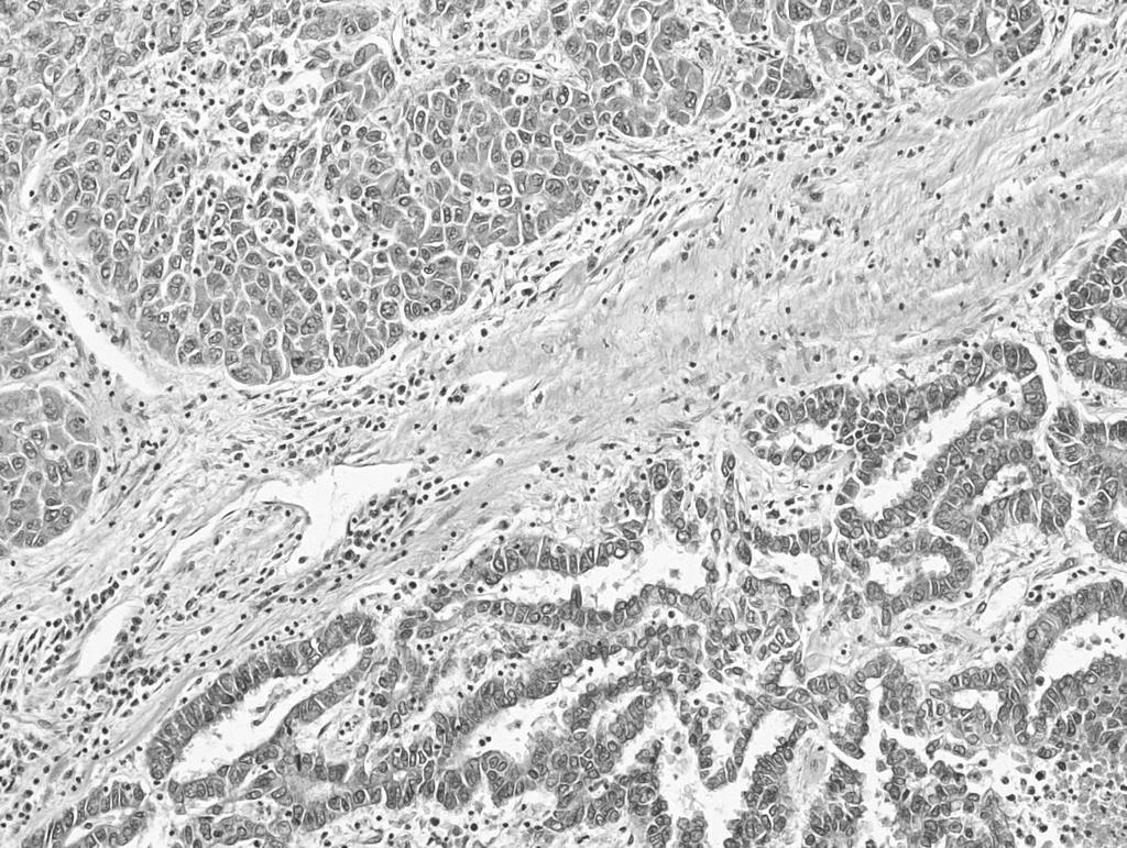 간세포암종의섬유층판변이 (fibrolamelarvariant) 를닮고, 점액분비와거짓샘구조를보인다.