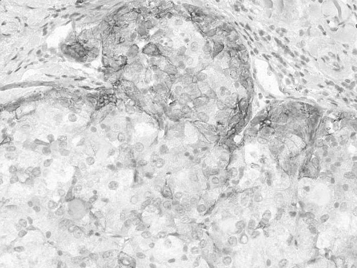 이러한세포가종양의많은부분을차지할때줄기세포특징을가진복합간세포 -담관암종 (combinedhepatocelularcholangiocarcinoma with stem celfeatures) 이라하며 3가지아형으로분류한다. 1 