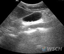 Ultrasound 에코가증가하므로문맥벽의에코가뚜렷이보이지않게된다 (Fig. 1B).