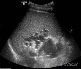 mildly blunted Irregular and blunted Parenchyma echogenicity Fine Mildly coarse Coarse Right lobe atrophy Absent a Present b Spleen size (cm) <10 10-14 >14 Splenic vein diameter (cm) <0.7 0.7-0.9 >0.
