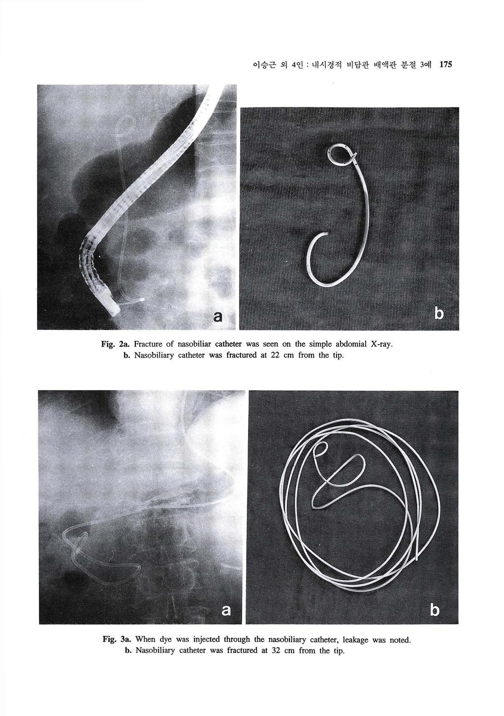 이승근외 4 인 : 내시경적비담관배액관분절 3 예 175 Fig. 2a. Fracture of nasobi1iar catheter was seen on the simple abdomial X-ray b.