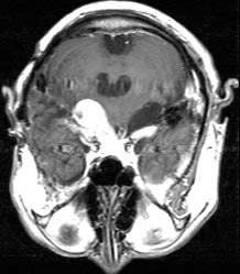 안중호외 - - Fig. 2. A case of cerebellopontine angle tumor.
