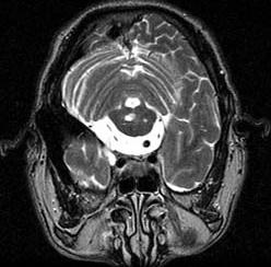 8 cm sized, well-enhanced mass in right cerebellopontine