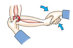 - 손목과손가락을과다하게사용할경우에발생 - 팔꿈치내바깥쪽에통증을유발한다.
