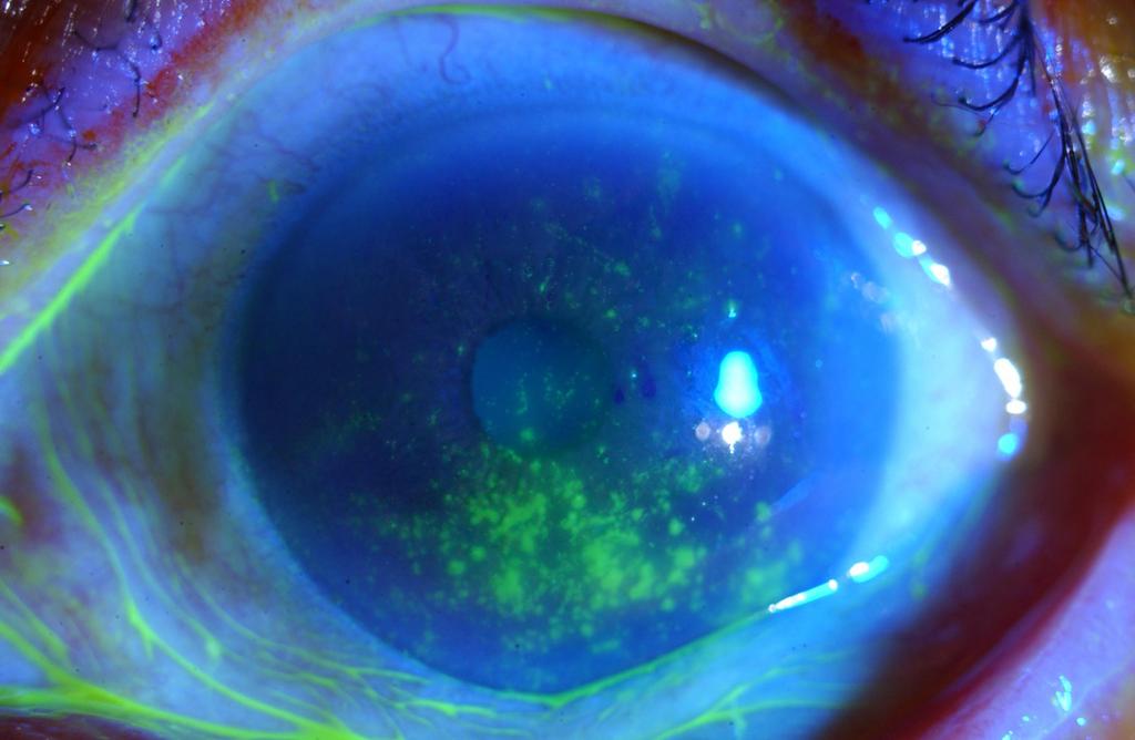 - 주광식외 : 건성안에서헤파린과인지질의치료효과 - A B Figure. In patient with a history of recurrent herpetic epithelial keratitis, corneal erosion, plaque, and filaments are observed (A).