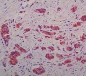 288 손진희 채승완 최경찬외 1 인 Fig. 1. Immunohistochemistry of caspase 3 in advanced gastric carcinoma. Many positive cells with cytoplasmic staining are scattered in the malignant glands. Fig. 3. Immunohistochemistry of Ki-67 in advanced gastric carcinoma.