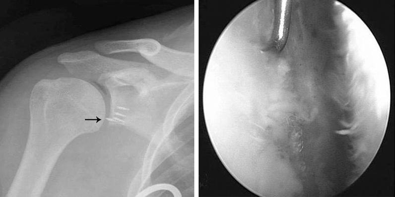 대한견 주관절학회지제 11 권제 2 호 A B Fig. 6. (A) simple radiograph showed an anchor protrusion to the articular surface in glenohumeral joint of the patient.