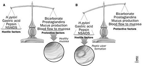 of peptic ulcer 1) 미국 H.