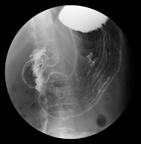gastroduodenal motility Suggestion of ulcer complication Dyspepsia constant, not relieved by food or antacids, or radiates to the