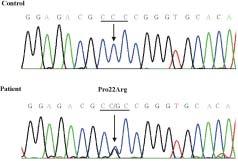 조현지정기화선우일남박기덕김대성서범천이미선윤은경최병옥 A B C Figure 4. Chromograms of three CMT families with NEFL mutations. (A) Sequencing analysis of NEFL exon 1.