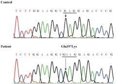 이와함께 FC#49 가족에서 NEFL 유전자의 1번째인트론에위치하는 1048-2 inst 에서이전에보고되지않았던새로운유전자다형성 (polymorphism) 이발견되었으나, 인트론에위치하는변이로 noncoding region 이므로원인유전자로는생각되지않았다. 이환자는원인유전자변이로염색체 17p11.2-p12 의중복도함께발견된특이한경우였다.