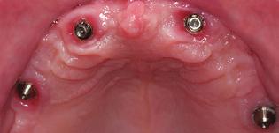 치과의사 전체임플란트치료제공 Implant