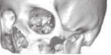 인공광대뼈 광대뼈결손부위대체 / 고정 / 유합