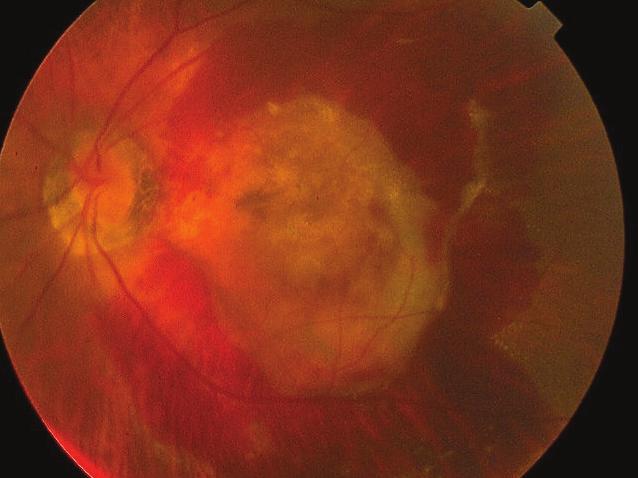 subretinal hemorrhage after photodynamic therapy.