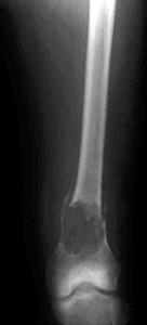 lesion of the left dital femur.