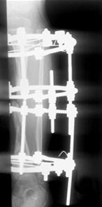 (A) Radiographs of a 4-year-old