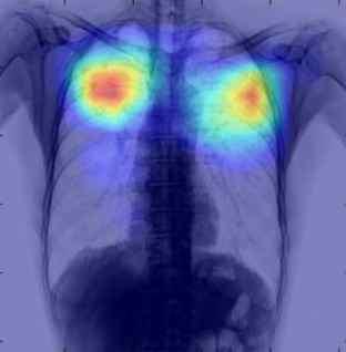 년부터서울아산병원과공동개발 의료영상 ( 흉부 X-Ray, 유방촬영술 )