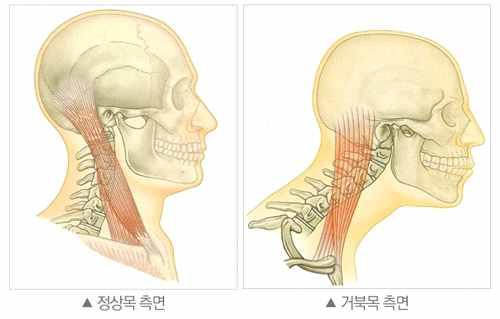 2) 거북목증후군 ( 일자목증후군 ) 최근컴퓨터작업및스마트폰의보급으로목을앞으로뺀자세를많이취하게된다. 이에의해바로선자세에서목을앞으로뺀자세를취하면거북목이라고한다. 전체목뼈수가 7개인데정상적으로는귀가어깨뼈봉우리와같은수직면상에있고 7개의목뼈는앞쪽으로 C자형으로휘어서배열되어있다. 이를경추전만이라고한다.