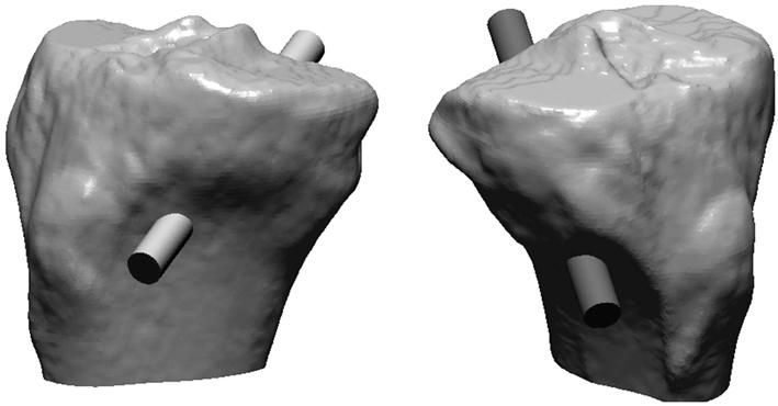 2013 년대한정형외과스포츠의학회추계학술대회 anteromedial starting points were generated (Fig. 2)