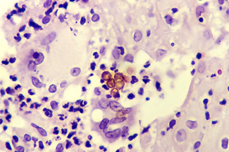 Large, dark brown, septate cells, i.e., sclerotic cells or muriform cells around giant cells (H & E stain, 400).
