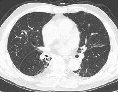 lungs and () the wall of the cavity in the RML is thinner. 베게너육아종증은환경요인과함께여러유전인자의상호작용으로인하여발생하는것으로추정되며, 이중 6번염색체의 HL-DP1이가장강한연관성을지니는것으로알려져있다 4).