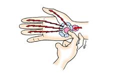 근골격계질환의종류및증상 ( 예 ) 수근관증후군 내 / 외상과염 - 반복적이고지속적인손목의압박이나손목을굽히는자세에서나타나며 -