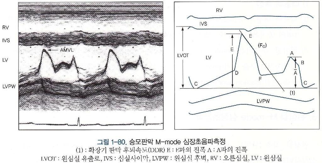 1) 승모판막 M-mode 심장초음파 : E/A파비율, 확장기판막후퇴속도 (DDR, EF경사 ),