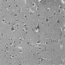신경세포이주장애질환과신경세사단백 415 A B C Fig. 1. (A) Normal or small sized dysplastic neurons (arrows) are noted among relatively normaly looking neurons.