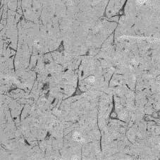 haphazardly oriented axons. (C) Immunohistochemical stain for NF-M disclosed weak immunoreactivity in abnormally thickened, haphazardly oriented axons.