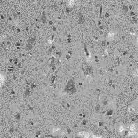 416 오현식 최유덕 김현중외 5 인 A B C Fig. 2. (A) Cytomegalic neurons (arrows) are noted among normal or small sized dysplastic neurons and relatively normal-looking neurons.