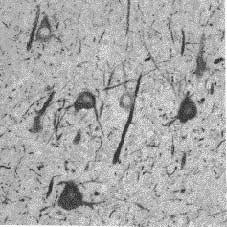 thickened, haphazardly oriented axons, and normal or small sized dysplastic neurons.