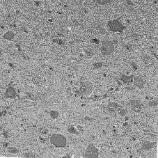 신경세포이주장애질환과신경세사단백 417 A B C Fig. 3. (A) Balloon cells with eccentrically located nucleus and eosinophilic cytoplasm (arrows) are noted.