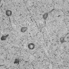 oriented axons. (C) Immunohistochemical stain for NF-M disclosed immunoreactivity in balloon cells and abnormally thickened, haphazardly oriented axons.