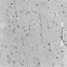 cal laminar disorganization), 백질내단일이소성신경세포, 피질분자층내이소신경원 (neurons in the molecular layer), 연막하과립성신경세포의잔존및변연부이소신경교-신경세포 (marginal glioneuronal heterotopia) 등이관찰될때로보았고, 중등도는소다뇌회증 (polymicrogyria),