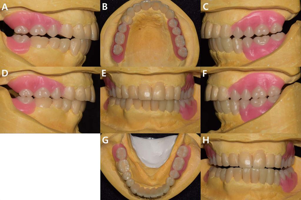 Rehabilitation of mandibular partial edentulous patient Fig. 3. Diagnostic wax up model.