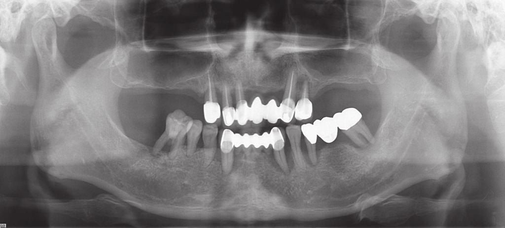 clinical case of hybrid telescopic double crown using friction pin with an isolated few remaining teeth 기에 pin을삽입하여내관과