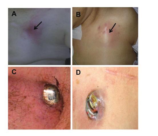 the location of the ventricular pacing lead changed (A). Perforation of right ventricular lead (B). A B C D Figure 2.