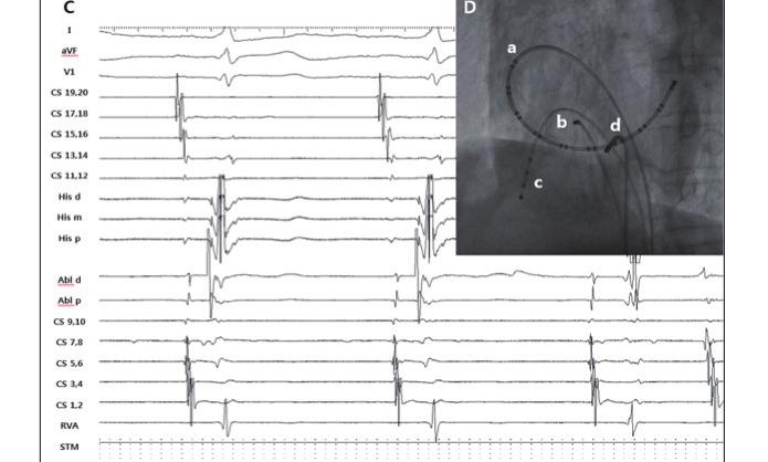 (C) Electrogram and (D) catheter position at the time of ablation. Ablation was actually carried out at a lower point than that depicted in (B).
