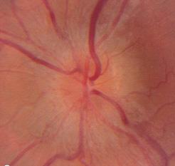 Optic neuritis associated with infectious diseases - Bacterial infections: syphilis, cat scratch diseases - Viral infections: herpes zoster, herpes simplex, HIV, EBV - Parasitic infections:
