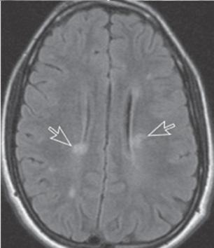 시신경염에서고해상도자기공명영상촬영을했을때시신경의조영증강은환자의 85% 까지나타날수있으며 (Fig. 2-A, B), 이러한조영증강은시신경염이발생한후 3주 A B C D E Figure 2. A-B.