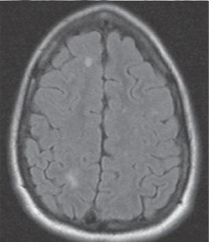 The MRI demonstrates focal enhancement of the left optic nerve (A), and in another patient more diffuse enhancement of the right