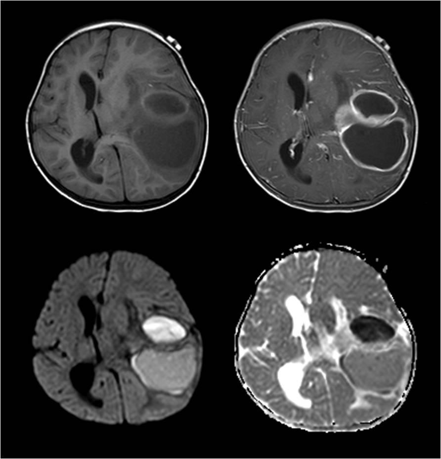 Acute pyogenic meningitis는 주로 혈행성 전파에 의해 감염 이 일어나며 발열, 두통 등 전형적 증상과 CSF 검사 결과로 확 인할 수 있다. 영상은 초기 CT에서 정상을 보이는 경우가 많고, MRI에서도 특별한 이상 소견이 없는 경우가 있다.
